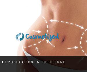 Liposuccion à Huddinge Liposuccion à Huddinge