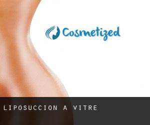 Liposuccion à Vitré Liposuccion à Vitré
